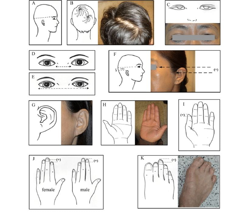 Birtakım küçük fiziksel anomaliler (minor physical anomalies).