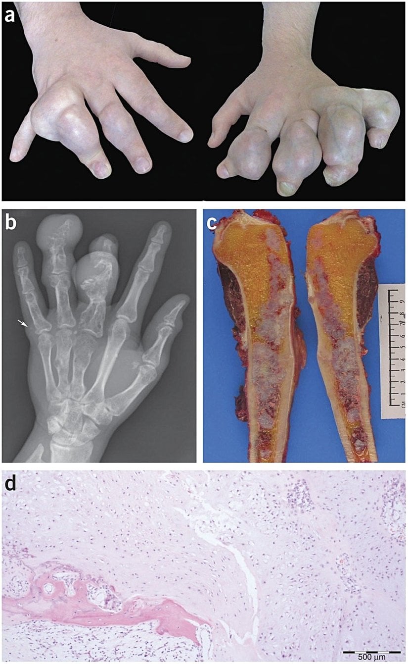 Ani etkili mutasyonlar sonucu oluşan fiziksel bir bozukluk, Ollier hastalığı...