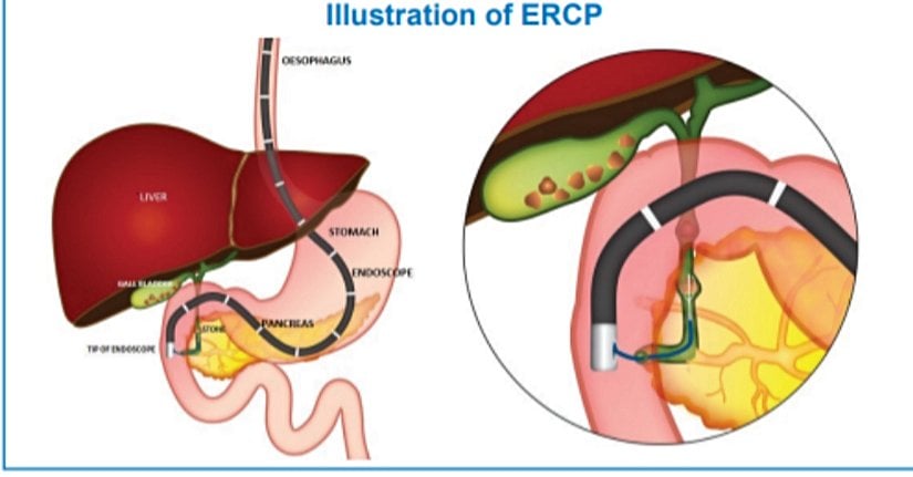 ERCP
