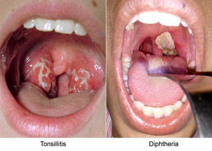 Tonsilit ve Difteri