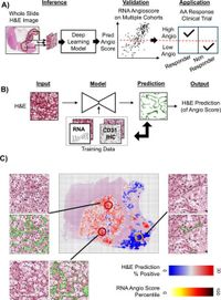 Histopathology based AI model predicts anti-angiogenic therapy response in renal cancer clinical trial - Nature Communications