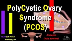 Study Links Polycystic Ovary Morphology And Uterine Anomalies