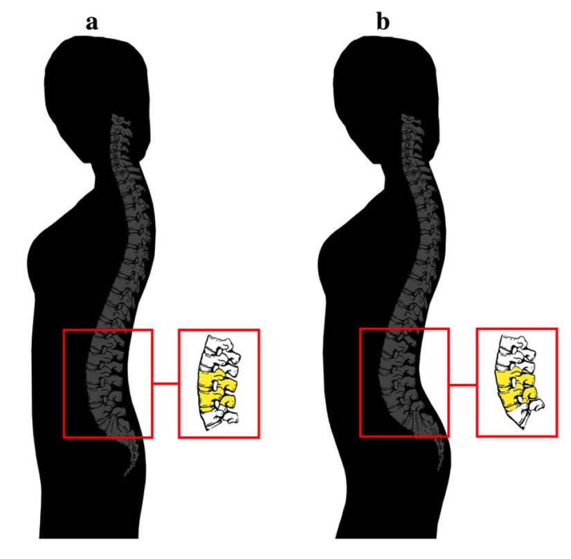 Lumbar curvature caused by wedging of the third-to-last lumbar vertebra.