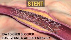 Stent Nedir?