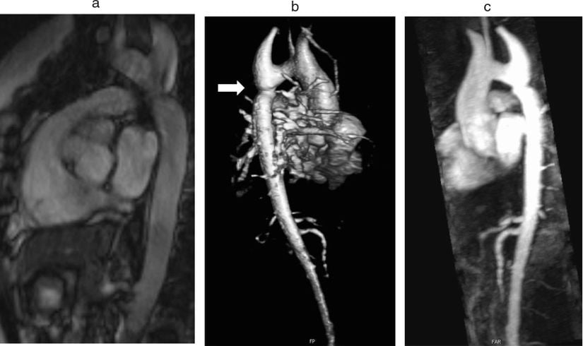 24 yaşındaki Turner Sendromlu bir kadında farklı projeksiyonlarda aort koarktasyonu (beyaz ok): (a) Sagital-eğik sine manyetik rezonans görüntüsü, (b) Hacimsel manyetik rezonans aortografi (arka-eğik görünüm), (c) Manyetik rezonans aortografi maksimum yoğunluk projeksiyonu (sagital eğik görünüm).