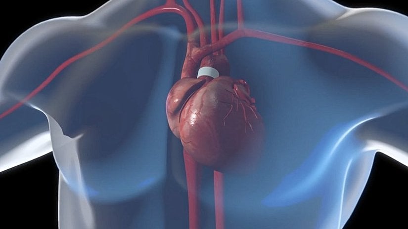 Uzay araştırmaları sonucu üretilen ürünler listemizin bir diğer maddesi ise kalp pompasıdır. 1990’larda ortaya çıkan ve kalp nakli bekleyen insanlara takılan kalp pompaları da Nasa’nin araştırmaları sonucu ortaya çıkan bir başka teknoloji. Eskiden kalp nakli bekleyen hastalar çok kısa sure içinde aradıkları kalbi bulmak zorundaydı ama simdi bu kalp pompaları sayesinde kalp nakli için beklerken normal hayatlarına da epeyce bir süre devam edebiliyorlar. Nasa’nın açıklamasına göre 2010 itibariyle bu şekilde kurtarılan hayat sayısı 450’yi geçmiş durumda.