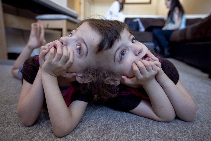 Fotoğrafa baktığınız yönde sol taraftaki ikiz "Tatiana Hogan", sağ taraftaki ikiz "Krista Hogan"dır.