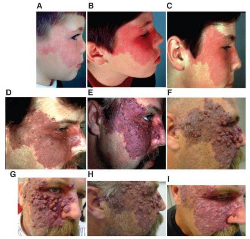Port Wine Stain Progression