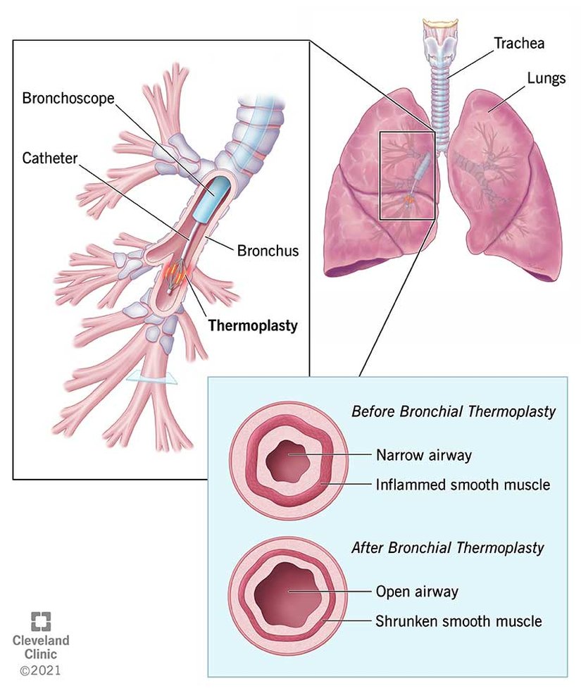 Bronşiyal termoplasti, astım semptomlarını azaltmak için akciğerlerdeki düz kasları küçültmek için ısı kullanır.