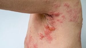 IBD Patients Face Increased Shingles Complications