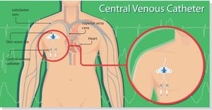 Oncologists Innovate Central Venous Catheter Placement Techniques