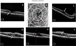 Early Detection Of Retinal Dysfunction Using MfERG