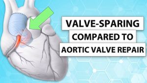 Valve-Sparing Root Replacement Outperforms Aortic Root Surgery