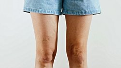 Genç Yaşta Varis Oluşumu: Bunlara Çok Dikkat Edin