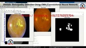 New Deep Learning Model Transforms Diabetic Retinopathy Detection