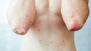 Psoriasis Patients Show Higher Rates Of Allergic Rhinitis