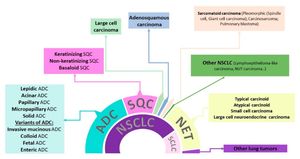 EXO1 Emerges As Key Gene For Lung Cancer Immunity Insights