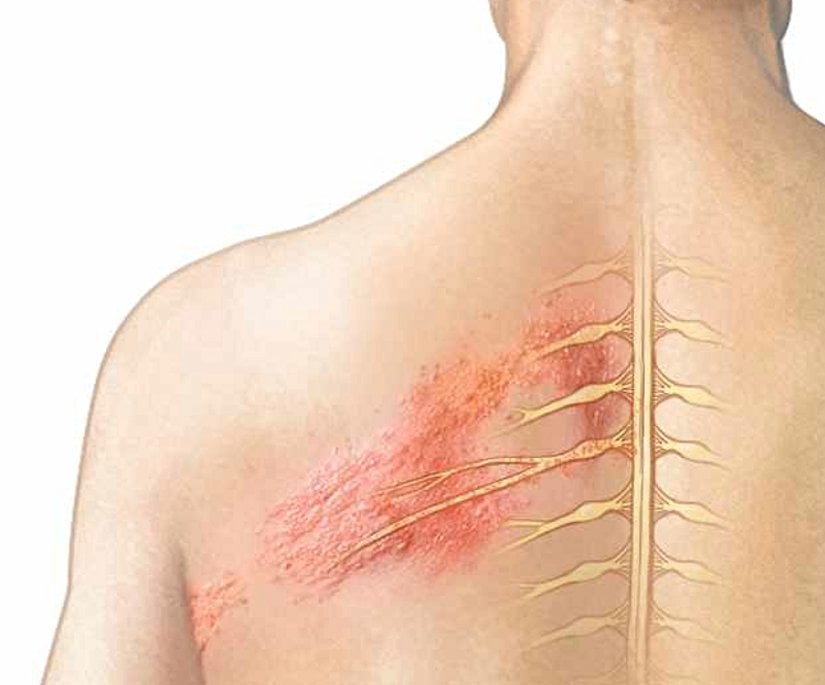 Sinirlerin innerve ettiği dermatom alanını tutmuş bir zona görüntüsü.