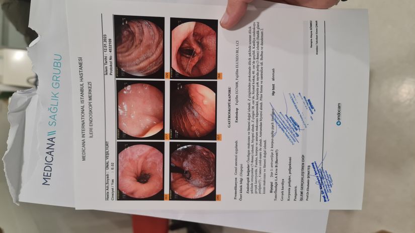 12/01/2023 tarihinde endoskopi oldum ve sol en baştaki resimde reflüyü görebilirsiniz ve kenarlardaki kızarıklıklar reflüye sebep olan mide asidinin tahriş ettiği yerler. Bizim şikayetimizin tam noktası orasıdır mide kapakçığının orası.