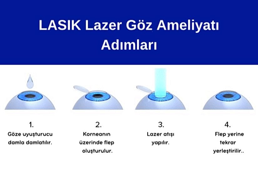 LASIK Lazer Göz Ameliyatı