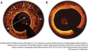 Study Reveals Risks Of Drug-Eluting Stents And Edge Effects