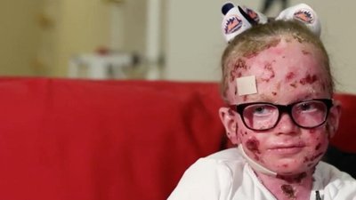 Epidermolizis Bülloza Nedir? Derisinde 