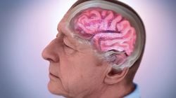 Alzheimer Amiloid-Beta Plaklarını Çözen Nanopartiküller Geliştirildi!