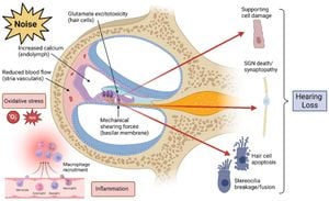 Machine Learning Model Enhances Detection Of Noise-Induced Hearing Loss