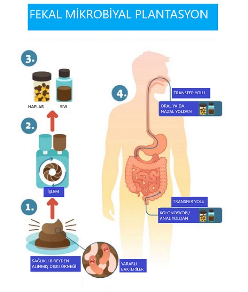 1.Aşamada sağlıklı bir kişiden alınan dengeli mikrobiyotaya sahip dışkı örneği 2. aşamada dışkı materyali belli tekniklerle 3. aşamadaki gibi farklı formlara dönüştürülür. Hap formu oral yoldan sıvı mikrobiyota elemanları ise anal yoldan hastaya verilir.