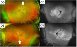 Study Reveals Impact Of COVID-19 On Retinal Health