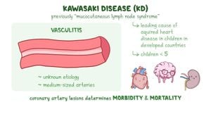 New Machine Learning Model Enhances Diagnosis Of Kawasaki Disease