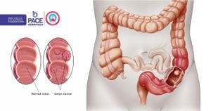 COVID-19 Pandemic Leads To Increased Severity Of Colorectal Cancer Cases