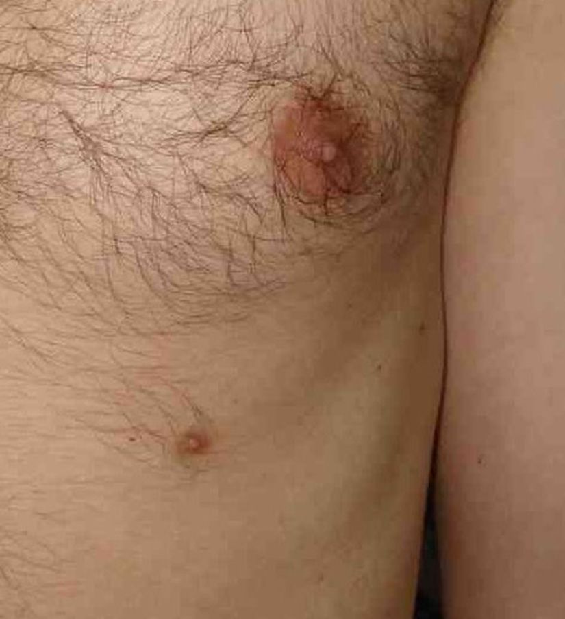 Supernumerary Nipple on Biological Male