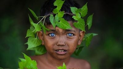 Waardenburg Sendromu Nedir? Hangi Genler Waardenburg Sendromuyla İlişkilidir?