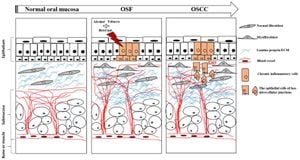 Novel Genes Uncovered Driving Malignant Transformation Of Oral Submucous Fibrosis