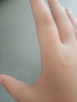 Köpek Isırması Kuduza Neden Olur mu?