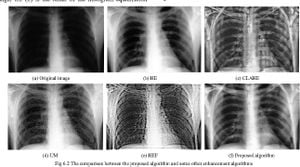 Enhancing Neonatal Chest X-Ray Quality With BO-CLAHE Method