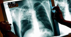 Kansas City Faces Historic Tuberculosis Outbreak