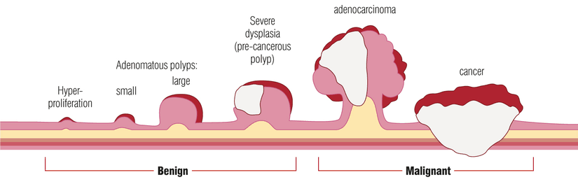 Kolorektal kanserin gelişim aşamaları
