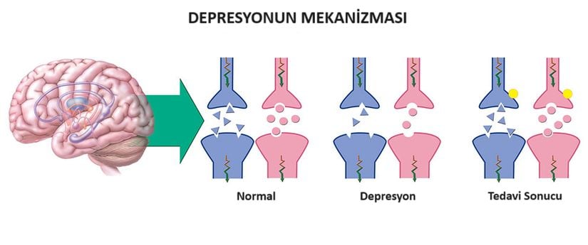 Serotoninin depresyon tedavisindeki yeri. Görselde &quot;Normal&quot; başlığının üstünde görünen kısımda iki hücre arasında normal miktardaki serotonin bulunuyor. &quot;Depresyon&quot; başlığının üstünde bulunan kısımda bir depresyon hastasının sinir hücreleri arasındaki serotonin miktarı gösterilmiş, göründüğü üzere normal bir kişiye göre daha az serotonin var. &quot;Tedavi Sonucu&quot; başlığı üstünde ise serotonin seviyesi düşük bir hastanın tedavi edilmesinden sonra iki hücre arasındaki serotonin seviyesinin &quot;normale döndüğü&quot; görünüyor.