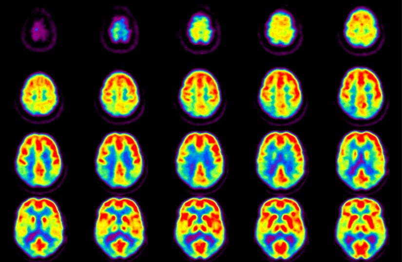 Beyin PET taraması.