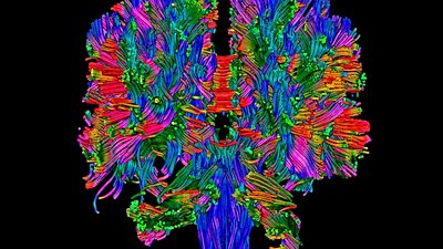 Beyninde İkiz Kardeşini Taşıyan Kadın!