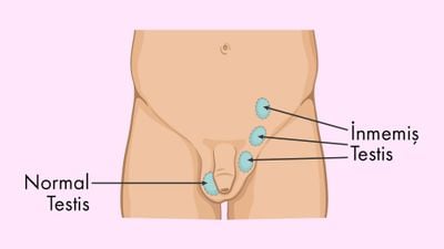 İnmemiş Testis Nedir? Nasıl Teşhis Edilir ve Nasıl Tedavi Edilir?