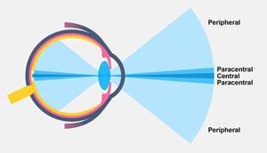 Impact Of SMILE Surgery On Peripheral Vision Examined