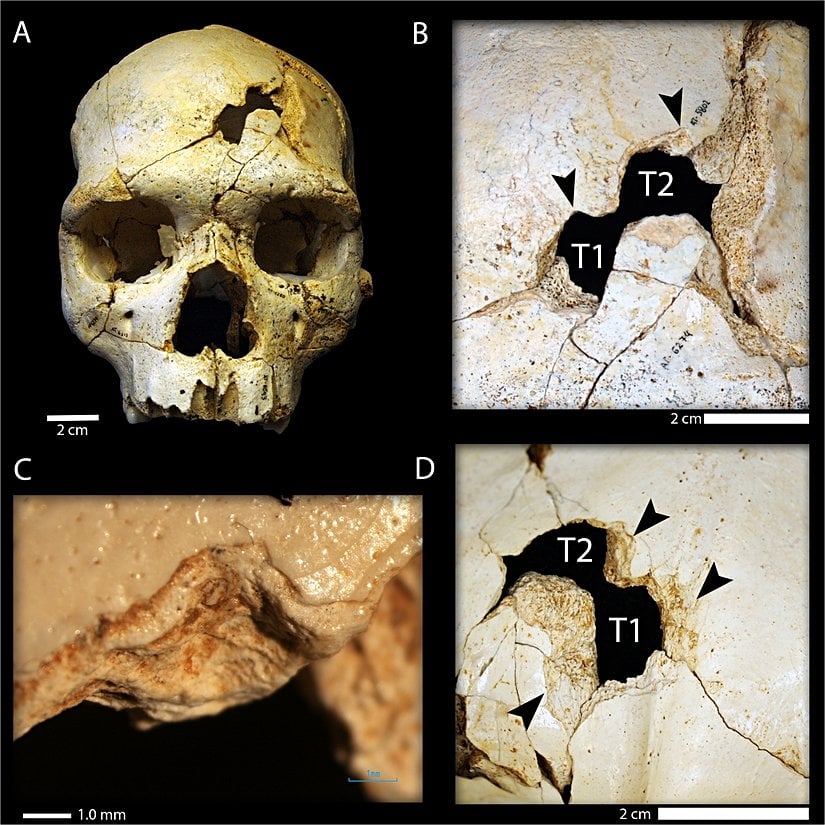430 bin yıl önce, muhtemelen kişilerarası şiddet sonucu öldürülmüş bir bireyin kafatası kalıntıları.
