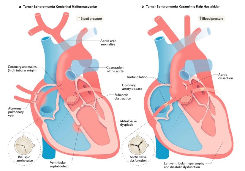 Turner Sendromunda konjenital ve kazanılmış kardiyak problemler. Kazanılmış kalp hastalıkları sıklıkla, konjenital malformasyonların üstünde meydana gelir. Örneğin, solda görülen biküspit aort kapağının mevcudiyeti aort dilatasyonu riskini artırır. Aort genişlemesi yetişkin yaşamı boyunca meydana gelir ve normals sınırı aşarsa aort diseksiyonunun öncüsü olabilir.