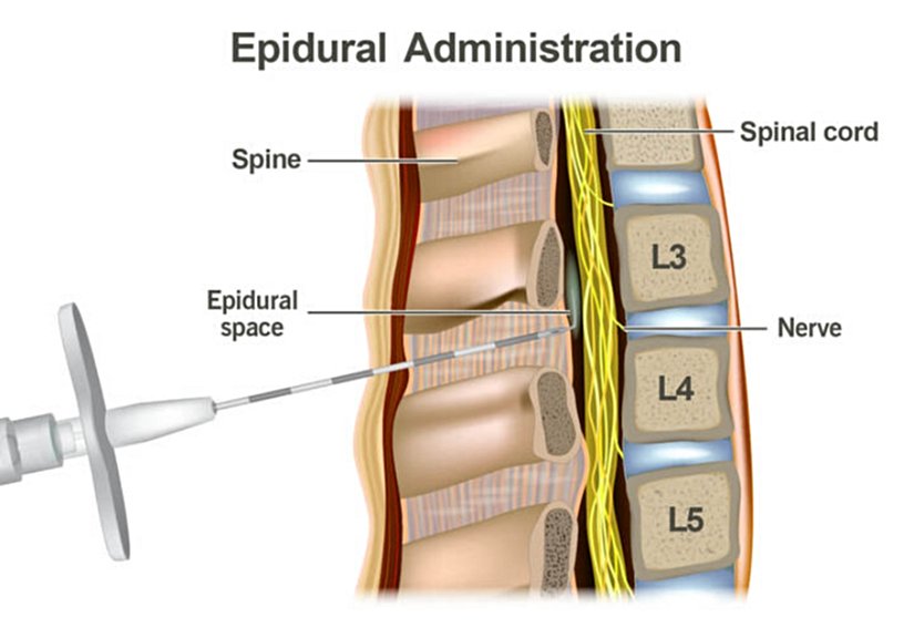 Epidural, epidural boşluk olarak bilinen omurilik sinirlerinin etrafındaki boşluğa ilaç enjekte eder.