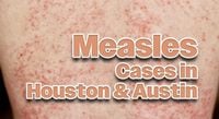 Houston and Austin Report New Measles Cases Within Statewide Outbreak