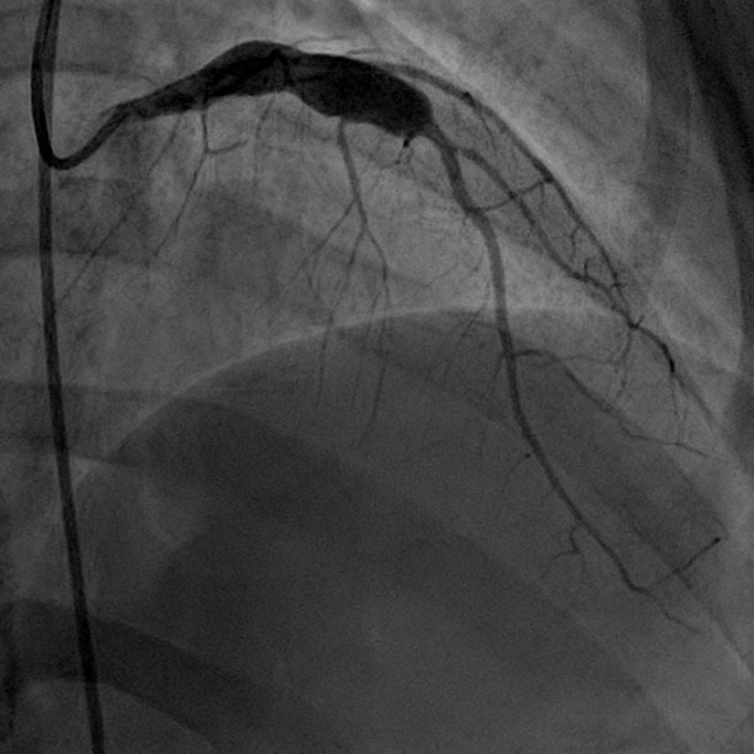 Akut semptomları gösteren hastada tanı amacıyla yapılan anjiyografi sonucu sol ön inen koroner arterde (kısaca LAD ) görülen anevrizma.