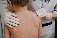 Children to be offered free chickenpox vaccine on NHS